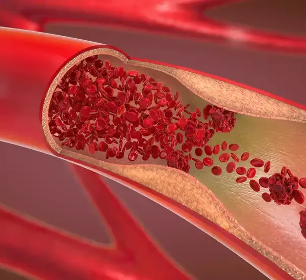 gestion de thrombus